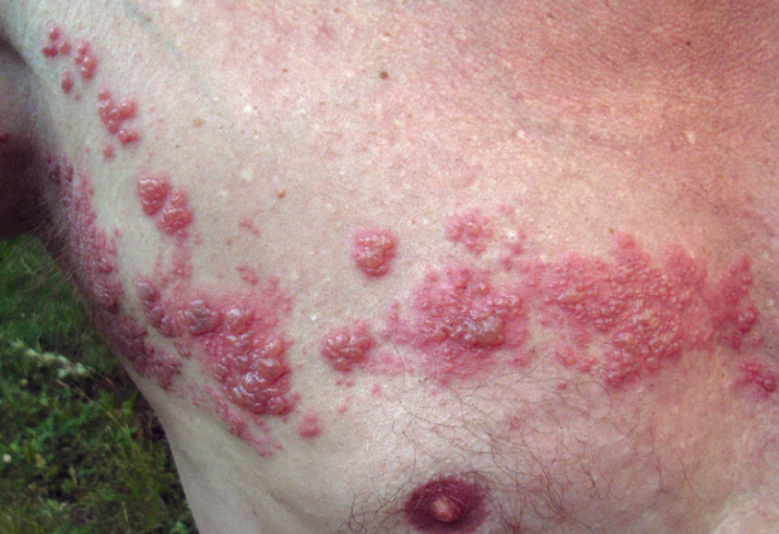 沙门氏菌感染症状是什么病