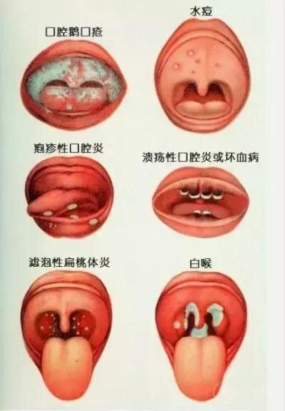 口腔常见病有哪些的相关图片